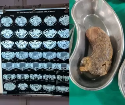 मुंबई के डॉक्टरों ने बच्ची के पेट से 100 ग्राम बालों का गुच्छा निकाला