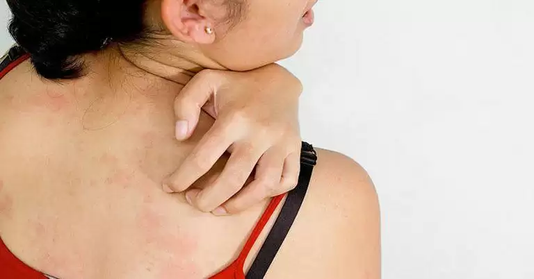 Skin एलर्जी से बचने के लिए घरेलू उपचार