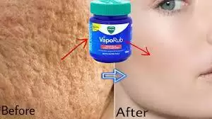 Vicks Vaporub से 5 मिनट में चेहरे के रोम छिद्र को जड़ से ख़त्म करे