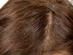 Hairtips:अगर आप भी बालों के Dandruff हैं परेशान तो अपनाये ये Tips