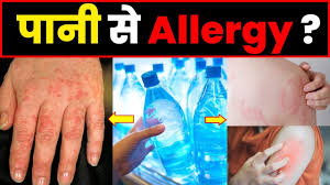 pani se allergy ho to kya karen :&nbsp; दुनिया में कुछ लोग ऐसे भी हैं जिन्हें जीवन के आधार 'पानी' से ही एलर्जी होती है। एक्वाजेनिक अर्टिकेरिया एक ऐसी ही दुर्लभ स्थिति है जिसमें पानी के संपर्क में आते ही त्वचा पर लाल चकत्ते, खुजली और जलन होने लगती है। हालाँकि इसका कोई निश्चित स्थायी इलाज नहीं है, लेकिन आधुनिक चिकित्सा और जीवनशैली में बदलाव के जरिए इसके लक्षणों को काफी हद तक कम&nbsp; किया जा सकता है।