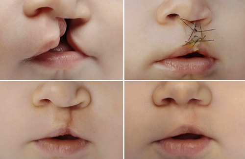 कटे होंठ व तालू से ग्रसित बच्चों के लिए विशेष स्वास्थ्य शिविर 18 दिसंबर को