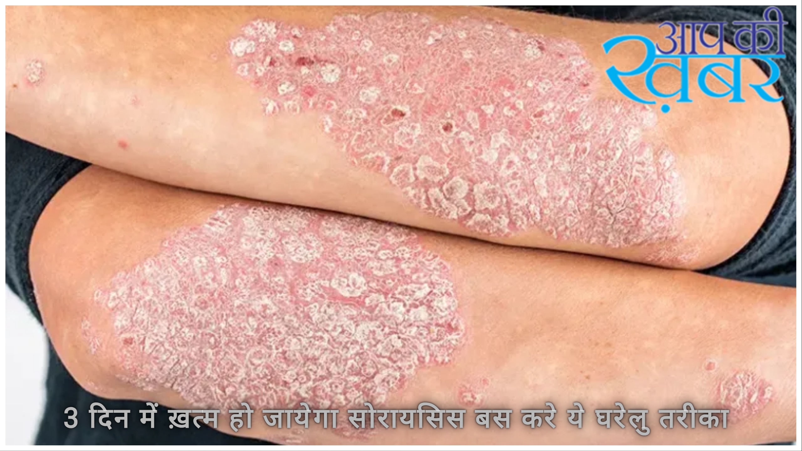 Psoriasis is a skin problem