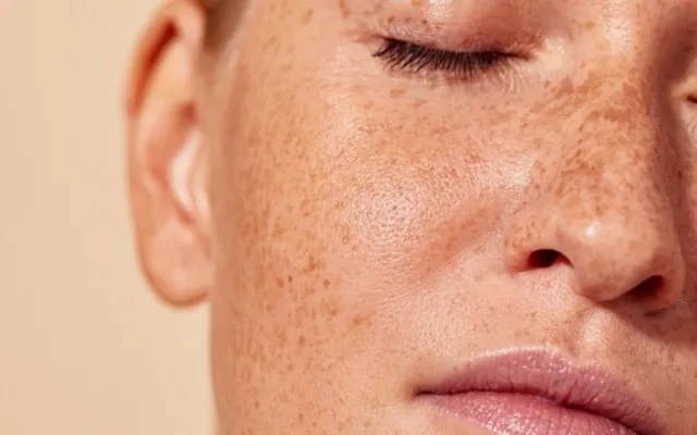 चेहरे की झाइयां (Melasma) छीन रही हैं आपकी चमक? जानें इसके मुख्य कारण और बचाव के अचूक घरेलू उपाय