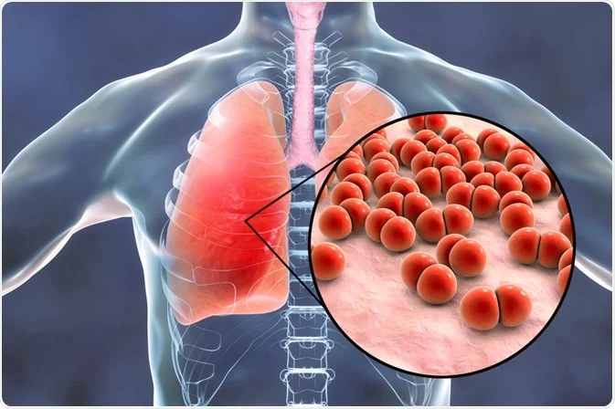 What Is The Main Cause Of Pneumonia