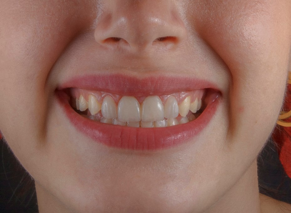 Yellow Teeth Remedies: मोतियों की तरह चमकेंगे आपके गंदे और पीले दांत! बस आजमाएं इस एक सस्ते फल के छिलके का जादुई नुस्खा